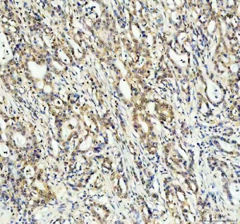IHC staining of FFPE human pancreas cancer tissue with CLOCK antibody. HIER: boil tissue sections in pH8 EDTA for 20 min and allow to cool before testing.