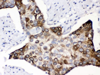 KIN Antibody Human Esophageal Squamous Cell Carcinoma IHC. Immunohistochemical staining of FFPE human esophageal squamous cell carcinoma tissue using KIN Antibody / DNA Repair Protein Antibody. Heat-induced epitope retrieval was performed in pH 8.0 EDTA buffer before incubation with KIN Antibody at 1 ug/ml. A biotinylated goat anti-rabbit secondary antibody with an SABC detection system and DAB chromogen was used for visualization. KIN staining is observed predominantly in the cytoplasm with membranous accentuation in tumor cells. This KIN Antibody, also called DNA Repair Protein Antibody, is suitable for studies of DNA repair, replication stress, and genome stability.