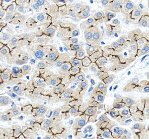 ABCB11 Antibody Canalicular Human Liver IHC. Immunohistochemical staining of FFPE human liver tissue using ABCB11 Antibody / Bile Salt Export Pump Antibody at 2 ug/ml. An HRP-conjugated goat anti-rabbit IgG secondary antibody with DAB substrate was used for detection. ABCB11 Antibody demonstrates strong canalicular membranous staining outlining adjacent hepatocytes in a characteristic chicken-wire pattern, consistent with the normal localization of the bile salt export pump in liver tissue.
