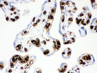 Band 3 Antibody Human Placenta IHC. Immunohistochemical staining of FFPE human placenta tissue using Band 3 Antibody / Anion Exchange Protein 1 Antibody demonstrates strong membranous and cytoplasmic HRP-DAB brown staining within placental trophoblast cell populations. Band 3 (AE1/SLC4A1) is a chloride/bicarbonate exchanger that mediates transmembrane ion transport and contributes to maintenance of acid-base balance and cellular ionic homeostasis. In addition to its well-established role in erythrocyte membrane physiology, Band 3 family proteins participate in transport processes that support cellular metabolism and physiologic homeostasis in specialized epithelial tissues. The observed placental staining pattern is consistent with expression of anion transport machinery involved in regulation of bicarbonate and chloride exchange. HIER: boil paraffin sections in pH 6, 10 mM citrate buffer for 20 minutes and allow to cool prior to staining.