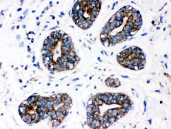 CYP1A1 Antibody Human Breast Cancer IHC. IHC staining of FFPE human breast cancer tissue with CYP1A1 antibody demonstrated strong cytoplasmic staining in malignant epithelial cells. CYP1A1 is a heme-containing cytochrome P450 monooxygenase that catalyzes Phase I xenobiotic metabolism and is induced through aryl hydrocarbon receptor (AHR) signaling following exposure to environmental toxicants. In addition to its role in chemical detoxification, CYP1A1 contributes to the metabolic activation of procarcinogens and has been implicated in tumor biology and therapeutic response. HIER was performed by boiling tissue sections in pH 6, 10 mM citrate buffer for 20 minutes followed by cooling prior to staining. These results support the utility of CYP1A1 Antibody for studies of xenobiotic metabolism, AHR signaling, environmental toxicology, and cancer research.