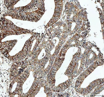 IHC staining of FFPE human endometrioid adenocarcinoma tissue with ATP1A1 antibody. HIER: boil tissue sections in pH8 EDTA for 20 min and allow to cool before testing.