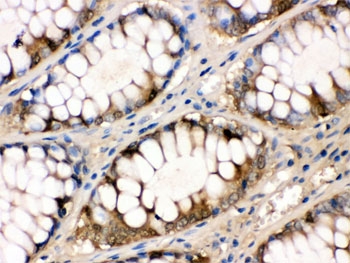 FABP Antibody Rabbit Polyclonal Intestinal Cancer IHC. Immunohistochemistry of FABP antibody in human intestinal cancer tissue. FFPE human intestinal carcinoma was stained with FABP antibody rabbit polyclonal. Predominant cytoplasmic HRP-DAB brown staining is observed in gland-forming tumor epithelial cells, consistent with Liver fatty acid binding protein expression in intestinal epithelium. Stromal cells show minimal staining. Heat induced epitope retrieval was performed by boiling paraffin sections in pH 6, 10 mM citrate buffer for 20 minutes followed by cooling prior to antibody incubation.