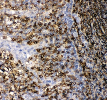 IHC staining of FFPE human tonsil tissue with CD45 antibody. HIER: Boil the paraffin sections in pH8 EDTA buffer for 20 minutes and allow to cool prior to staining.