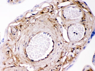 Galectin 1 Antibody Human Placenta IHC. Immunohistochemical staining of FFPE human placenta tissue using Galectin 1 antibody demonstrates prominent cytoplasmic and extracellular matrix-associated HRP-DAB brown staining within placental stromal and vascular-associated cellular structures. The observed staining pattern is consistent with expression of Galectin-1 (LGALS1), a beta-galactoside-binding lectin involved in cell adhesion, immune tolerance, angiogenesis, and maternal-fetal communication. Galectin-1 is known to contribute to placental development, trophoblast function, and regulation of the immune environment at the maternal-fetal interface. The results support the utility of the Galectin 1 antibody for detection of endogenous LGALS1 expression in FFPE placental tissue. HIER: boil paraffin sections in pH 6, 10mM citrate buffer for 20 minutes and allow to cool prior to staining.