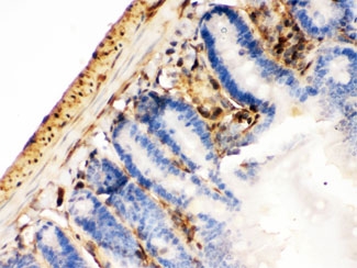 Galectin 1 Antibody Mouse Intestinal Cancer IHC. Immunohistochemical staining of FFPE mouse intestinal cancer tissue using Galectin 1 antibody demonstrates cytoplasmic and membranous HRP-DAB brown staining within neoplastic epithelial cells and adjacent stromal elements. The staining pattern is consistent with expression of Galectin-1 (LGALS1), a beta-galactoside-binding lectin involved in cell adhesion, immune regulation, extracellular matrix remodeling, angiogenesis, and tumor progression. Positive immunoreactivity is observed throughout tumor-associated cellular compartments, supporting the role of Galectin-1 in intestinal tumor biology and tumor microenvironment signaling. HIER: boil paraffin sections in pH 6, 10mM citrate buffer for 20 minutes and allow to cool prior to staining.