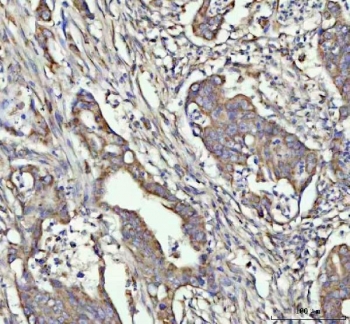 G-CSF Antibody Colorectal Tumor IHC. Immunohistochemistry of Granulocyte colony stimulating factor / CSF3 in FFPE human rectum adenocarcinoma tissue using G-CSF antibody. HRP-DAB brown staining highlights cytoplasmic labeling in tumor epithelial cells forming glandular structures, with additional staining in surrounding stromal components, consistent with cytokine-associated expression within the tumor microenvironment, while nuclei are counterstained blue. Heat induced epitope retrieval was performed by boiling tissue sections in pH 8 EDTA for 20 min followed by cooling prior to staining.