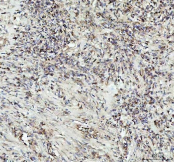 G-CSF Antibody Lung Squamous Tumor IHC. Immunohistochemistry of Granulocyte colony stimulating factor / CSF3 in FFPE human lung squamous cell carcinoma tissue using G-CSF antibody. HRP-DAB brown staining highlights cytoplasmic labeling in malignant squamous cells with a diffuse and heterogeneous distribution, along with staining in tumor-associated stromal cells, consistent with cytokine-related expression within the tumor microenvironment, while nuclei are counterstained blue. Heat induced epitope retrieval was performed by boiling tissue sections in pH 8 EDTA for 20 min followed by cooling prior to staining.