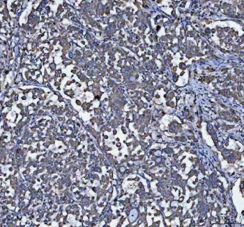 IHC staining of FFPE human lung adenocarcinoma tissue with GRP78 antibody. HIER: boil tissue sections in pH8 EDTA for 20 min and allow to cool before testing.
