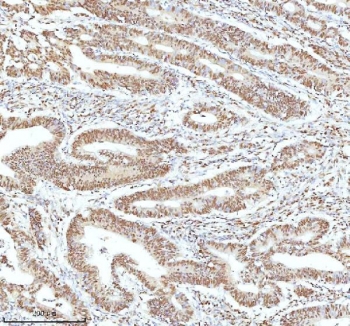 Ku70 Antibody Colon Adenocarcinoma IHC. Immunohistochemistry analysis of FFPE human colon adenocarcinoma tissue stained with Ku70 Antibody demonstrates strong predominantly nuclear HRP-DAB brown staining throughout gland-forming malignant epithelial tumor cell populations, consistent with XRCC6 / Ku70-associated DNA repair pathway expression. This DNA end binding protein antibody highlights double-strand break repair signaling and genomic maintenance-associated cellular regulation within colorectal carcinoma tissue. HIER: boil tissue sections in pH8 EDTA for 20 min and allow to cool before testing.