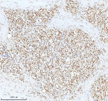 Ku70 Antibody Colon Adenocarcinoma IHC. Immunohistochemistry analysis of FFPE human colon adenocarcinoma tissue stained with Ku70 Antibody demonstrates strong predominantly nuclear HRP-DAB brown staining throughout gland-forming malignant epithelial tumor cell populations, consistent with XRCC6 / Ku70-associated DNA repair pathway expression. This DNA end binding protein antibody highlights double-strand break repair signaling and genomic maintenance-associated cellular regulation within colorectal carcinoma tissue. HIER: boil tissue sections in pH8 EDTA for 20 min and allow to cool before testing.