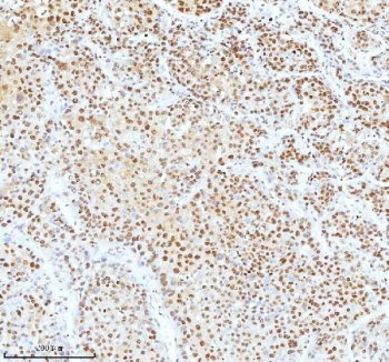 Ku70 Antibody Liver Cancer IHC. Immunohistochemistry analysis of FFPE human liver cancer tissue stained with Ku70 Antibody demonstrates strong diffuse nuclear HRP-DAB brown staining throughout malignant hepatic tumor cell populations, consistent with XRCC6 / Ku70-associated DNA damage response pathway expression. This DNA end binding protein antibody highlights non-homologous end joining-associated repair signaling and genomic stability regulation within hepatocellular carcinoma-associated tissue compartments. HIER: boil tissue sections in pH8 EDTA for 20 min and allow to cool before testing.