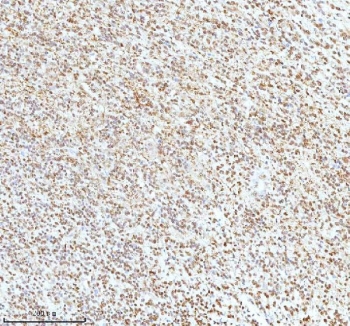 Ku70 Antibody Glioblastoma IHC. Immunohistochemistry analysis of FFPE human glioblastoma tissue stained with Ku70 Antibody demonstrates widespread nuclear HRP-DAB brown staining throughout densely cellular malignant glial-associated tumor populations, consistent with XRCC6 / Ku70-associated DNA repair pathway expression. This DNA end binding protein antibody highlights double-strand break repair signaling and genomic maintenance-associated cellular regulation within high-grade glioma tissue. HIER: boil tissue sections in pH8 EDTA for 20 min and allow to cool before testing.