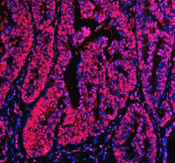 Ku70 Antibody Colon Cancer Immunofluorescence. Immunofluorescent analysis of FFPE human colon cancer tissue stained with Ku70 Antibody demonstrates strong nuclear and chromatin-associated red fluorescence throughout malignant gland-forming epithelial tumor cell populations, consistent with XRCC6 / Ku70-associated DNA damage response pathway localization. This DNA end binding protein antibody highlights non-homologous end joining-associated repair signaling and genomic stability regulation within colorectal carcinoma tissue. Nuclei are counterstained with DAPI nuclear stain (blue). HIER: steam section in pH8 EDTA buffer for 20 min.