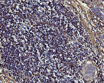 IHC staining of lymph node in FFPE human gastric adenocarcinoma-rectal cancer with MMP9 antibody. HIER: boil tissue sections in pH8 EDTA for 20 min and allow to cool before testing.