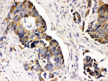 PDGFR Alpha Antibody Intestinal Cancer IHC. Immunohistochemistry staining of FFPE human intestinal cancer tissue using PDGFR Alpha Antibody / Receptor Tyrosine Kinase Antibody demonstrates cytoplasmic and membranous HRP-DAB brown staining within malignant gland-forming epithelial cells. The staining pattern is consistent with expression of PDGFRA, a receptor tyrosine kinase that mediates platelet-derived growth factor signaling and regulates cellular proliferation, migration, differentiation, and survival. PDGFRA has been implicated in tumor-associated growth factor signaling networks and contributes to cellular communication within the tumor microenvironment. The observed staining highlights PDGFRA expression in intestinal carcinoma-associated epithelial populations. HIER was performed by boiling tissue sections in pH 6, 10 mM citrate buffer for 20 minutes followed by cooling prior to immunostaining.