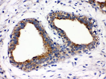 FUT1 Antibody Breast Cancer IHC. Immunohistochemistry staining of FFPE human breast cancer tissue using FUT1 Antibody demonstrates moderate to strong membranous and cytoplasmic HRP-DAB brown staining within malignant epithelial cells lining glandular and duct-like tumor structures. The staining pattern is consistent with expression of Fucosyltransferase 1 (FUT1), a Golgi-associated glycosyltransferase responsible for blood group H antigen biosynthesis and regulation of cell surface fucosylation. FUT1-mediated glycosylation influences cellular adhesion, receptor function, and cell-cell recognition processes, and altered expression has been associated with cancer-related changes in glycan composition and tumor cell behavior. The observed staining highlights neoplastic epithelial populations and is consistent with the known role of FUT1 in regulating biologically active cell surface carbohydrate structures. HIER: boil paraffin sections in pH 6, 10 mM citrate buffer for 20 minutes and allow to cool prior to staining.