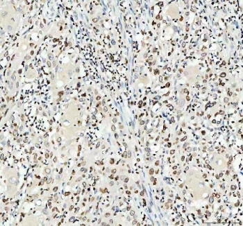 IHC staining of FFPE human urothelial carcinoma tissue with LMNB1 antibody. HIER: boil tissue sections in pH8 EDTA for 20 min and allow to cool before testing.