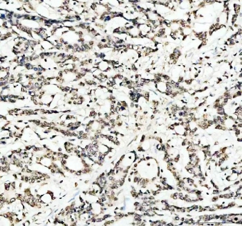 IHC staining of FFPE human colorectal adenocarcinoma tissue with LMNB1 antibody. HIER: boil tissue sections in pH8 EDTA for 20 min and allow to cool before testing.