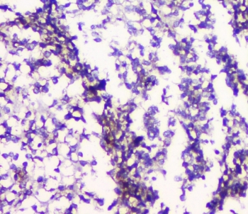 5HT2AR Antibody Human Glioma IHC. Immunohistochemical staining of FFPE human glioma tissue using 5HT2AR Antibody at 1 ug/ml. HIER was performed in pH 6 citrate buffer. An HRP-conjugated secondary antibody with DAB substrate was used for detection. 5HT2AR Antibody, a Serotonin Receptor Antibody, demonstrates predominantly cytoplasmic staining in glioma cells with minimal background staining in the surrounding tissue.