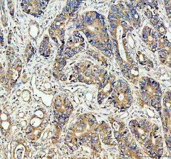 IHC staining of FFPE human stomach cancer tissue with CDC25B antibody. HIER: boil tissue sections in pH8 EDTA for 20 min and allow to cool before testing.