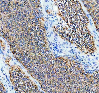 IHC staining of FFPE human ovarian cancer tissue with SDHA antibody. HIER: boil tissue sections in pH8 EDTA for 20 min and allow to cool before testing.