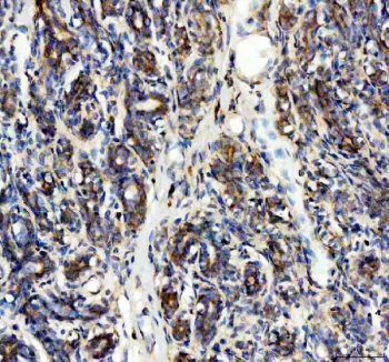 IHC staining of FFPE human breast cancer tissue with SDHA antibody. HIER: boil tissue sections in pH8 EDTA for 20 min and allow to cool before testing.
