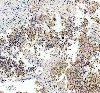 IHC staining of FFPE human lung cancer tissue with STAT3 antibody, HRP-secondary and DAB substrate. HIER: boil tissue sections in pH8 EDTA for 20 min and allow to cool before testing.