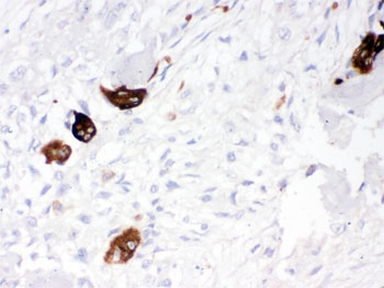 CTSK Antibody Osteosarcoma Immunohistochemistry. IHC testing of FFPE human osteosarcoma tissue with CTSK antibody. HIER: Boil the paraffin sections in pH 6, 10mM citrate buffer for 20 minutes and allow to cool prior to staining.