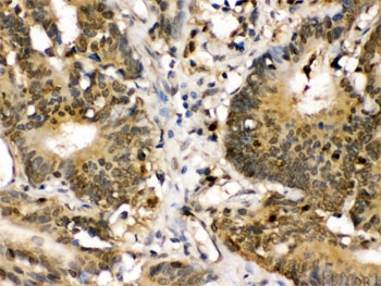 MKK3 Antibody / p38 MAP Kinase Kinase Antibody Human Intestinal Cancer IHC. Immunohistochemical staining of FFPE human intestinal cancer tissue using MKK3 Antibody / p38 MAP Kinase Kinase Antibody. MKK3 expression is detected predominantly within the cytoplasm of tumor cells, consistent with its role as a dual-specificity kinase that activates the p38 MAPK signaling pathway in response to inflammatory cytokines and cellular stress. Heat-induced epitope retrieval was performed by boiling tissue sections in pH 6.0 citrate buffer for 20 minutes followed by cooling before staining. Immunoreactivity supports the utility of this antibody for investigating stress-responsive signaling, inflammation, apoptosis, and cancer-associated p38 MAPK activation.