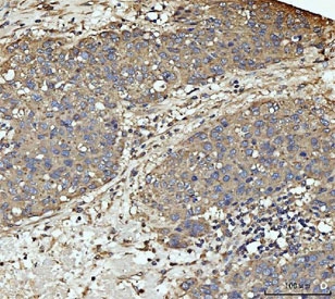 MKK3 Antibody / p38 MAP Kinase Kinase Antibody Human Liver Cancer IHC. Immunohistochemical staining of FFPE human liver cancer tissue using MKK3 Antibody / p38 MAP Kinase Kinase Antibody. MKK3 expression is detected predominantly within the cytoplasm of tumor cells, consistent with its role as a stress-responsive dual-specificity kinase that activates the p38 MAPK signaling pathway in response to inflammatory cytokines and cellular stress. Heat-induced epitope retrieval was performed in pH 8.0 EDTA buffer for 20 minutes followed by cooling before staining. This staining pattern supports the use of the antibody for investigating p38 MAPK signaling, inflammatory responses, apoptosis, and liver cancer biology.testing.
