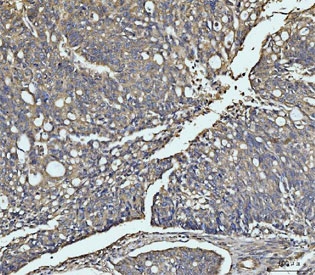 MKK3 Antibody / p38 MAP Kinase Kinase Antibody Human Ovarian Cancer IHC. Immunohistochemical staining of FFPE human ovarian cancer tissue using MKK3 Antibody / p38 MAP Kinase Kinase Antibody. MKK3 expression is detected predominantly within the cytoplasm of tumor cells, consistent with its function as a stress-responsive dual-specificity kinase that activates the p38 MAPK signaling pathway in response to inflammatory cytokines and environmental stress. Heat-induced epitope retrieval was performed in pH 8.0 EDTA buffer for 20 minutes followed by cooling before staining. This staining pattern demonstrates the utility of the antibody for investigating p38 MAPK signaling, inflammatory responses, apoptosis, and ovarian cancer biology.
