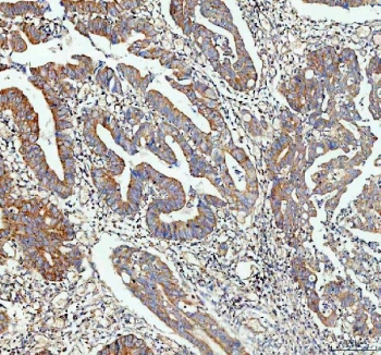 IHC staining of FFPE human colon cancer tissue with IDH2 antibody. HIER: boil tissue sections in pH8 EDTA for 20 min and allow to cool before testing.