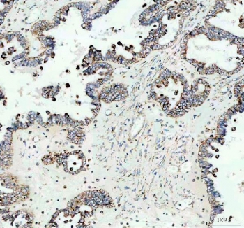 IHC staining of FFPE human ovarian cancer tissue with IDH2 antibody. HIER: boil tissue sections in pH8 EDTA for 20 min and allow to cool before testing.