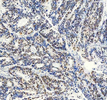 IHC staining of FFPE human colon cancer tissue with FOXA3 antibody. HIER: boil tissue sections in pH8 EDTA for 20 min and allow to cool before testing.