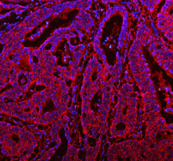 Immunofluorescent staining of FFPE human colon cancer tissue with RAB14 antibody (red) and DAPI nuclear stain (blue). HIER: steam section in pH8 EDTA buffer for 20 min.