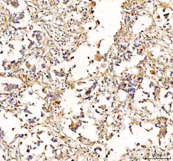 IHC staining of FFPE human breast cancer tissue with RAB14 antibody, HRP-labeled secondary and DAB substrate. HIER: boil tissue sections in pH8 EDTA for 20 min and allow to cool before testing.