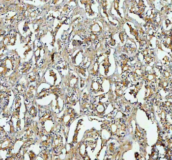 IHC staining of FFPE human ovarian cancer tissue with RAB14 antibody, HRP-labeled secondary and DAB substrate. HIER: boil tissue sections in pH8 EDTA for 20 min and allow to cool before testing.