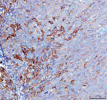 IHC staining of FFPE human non-keratotic squamous cell carcinoma of the cervix tissue with RAB14 antibody, HRP-labeled secondary and DAB substrate. HIER: boil tissue sections in pH8 EDTA for 20 min and allow to cool before testing.