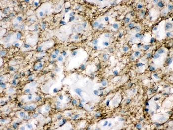 MUNC18-1 Antibody Human Glioma IHC. Immunohistochemical staining of FFPE human glioma tissue with MUNC18-1 antibody. Heat-induced epitope retrieval (HIER) was performed by boiling tissue sections in pH 6, 10 mM citrate buffer for 20 minutes and allowing them to cool prior to staining. Strong MUNC18-1 immunoreactivity is observed predominantly within the cytoplasm and along the cell membranes of glioma cells, consistent with the expected intracellular localization of STXBP1. Cell nuclei are counterstained with hematoxylin (blue).