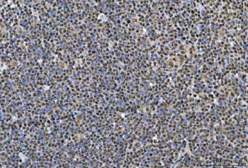 IHC staining of FFPE human lymphoma tissue with SNRPN antibody. HIER: boil tissue sections in pH8 EDTA for 20 min and allow to cool before testing.