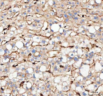 IHC staining of FFPE human liver cancer tissue with Actin antibody. HIER: Boil the paraffin sections in pH8 EDTA buffer for 20 minutes and allow to cool prior to staining.