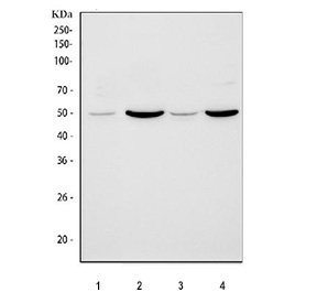 SMAD3 / MADH3 Antibody Human Liver Cancer IHC. Immunohistochemistry was performed on paraffin-embedded human liver cancer tissue using SMAD3 / MADH3 Antibody at 2 ug/ml. Heat-induced epitope retrieval was carried out in pH 8 EDTA buffer, and the tissue was incubated with the primary antibody overnight at 4Â°C. Bound antibody was detected using an HRP-conjugated goat anti-rabbit IgG secondary antibody and DAB chromogen. Strong cytoplasmic staining is observed throughout the liver carcinoma cells, while the surrounding stromal tissue exhibits comparatively low background staining. These results demonstrate that this MADH3 Antibody is suitable for immunohistochemical detection of SMAD3 in formalin-fixed, paraffin-embedded human liver cancer tissue.
