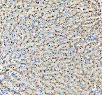IHC staining of FFPE human liver cancer tissue with mtTFA antibody, HRP-labeled secondary and DAB substrate. HIER: boil tissue sections in pH8 EDTA for 20 min and allow to cool before testing.