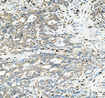 IHC staining of FFPE human pancreas cancer tissue with mtTFA antibody, HRP-labeled secondary and DAB substrate. HIER: boil tissue sections in pH8 EDTA for 20 min and allow to cool before testing.
