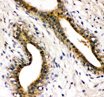 Immunohistochemical staining of FFPE human breast cancer tissue with SHP-2 antibody, HRP-secondary and DAB substrate. HIER: boil tissue sections in pH8 EDTA for 20 min and allow to cool before testing.