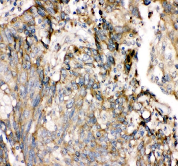 Immunohistochemical staining of FFPE human lung cancer tissue with SHP-2 antibody, HRP-secondary and DAB substrate. HIER: boil tissue sections in pH8 EDTA for 20 min and allow to cool before testing.