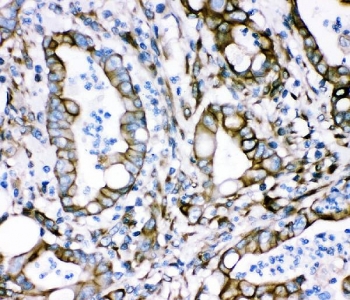 Plectin Antibody Intestinal Cancer IHC. Immunohistochemical staining of FFPE human intestinal cancer demonstrates plectin expression using a Plectin antibody. Plectin is a large cytolinker protein that connects intermediate filaments with membrane associated complexes to maintain cellular architecture and mechanical stability. Strong membranous and cytoplasmic staining is observed in malignant glandular epithelial cells, consistent with the elevated expression and altered cytoskeletal organization associated with tumor progression. Heat induced epitope retrieval was performed by boiling paraffin sections in pH 8 EDTA buffer for 20 minutes followed by cooling prior to staining. These results support the utility of Plectin Antibody for studies of cell adhesion, cytoskeletal dynamics, and cancer biology.