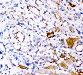 Plectin Antibody Lung Cancer IHC. Immunohistochemical staining of FFPE human lung cancer demonstrates plectin expression using a Plectin antibody. Plectin is a multifunctional cytolinker protein that stabilizes intermediate filaments and anchors cytoskeletal networks to membrane associated complexes. Heterogeneous cytoplasmic and membranous staining is observed in subsets of malignant cells and tumor associated structures, consistent with the dynamic changes in cellular architecture and adhesion that accompany cancer progression. Heat induced epitope retrieval was performed by boiling paraffin sections in pH 8 EDTA buffer for 20 minutes followed by cooling prior to staining. These findings support the utility of Plectin Antibody for investigations of cytoskeletal organization, mechanotransduction, and tumor biology.