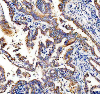 IHC analysis of STING/TMEM173 Antibody. STING expression was examined in a paraffin-embedded section of human lung cancer tissue. Following heat-mediated antigen retrieval in EDTA buffer (pH 8.0), sections were blocked with goat serum and incubated with a rabbit anti-STING/TMEM173 antibody. Immunoreactivity was visualized using an HRP-based detection system with DAB chromogen. STING staining is observed predominantly in tumor epithelial cells with cytoplasmic and membranous localization patterns, while surrounding stromal areas show lower background signal.